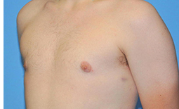 Gynecomastia Before and After Pictures Plano, TX