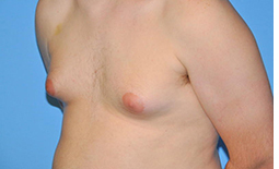 Gynecomastia Before and After Pictures Plano, TX