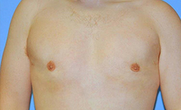 Gynecomastia Before and After Pictures Plano, TX