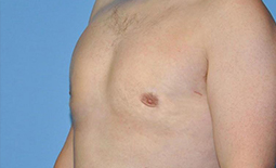 Gynecomastia Before and After Pictures Plano, TX