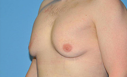 Gynecomastia Before and After Pictures Plano, TX