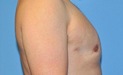 Gynecomastia Before and After Pictures Plano, TX