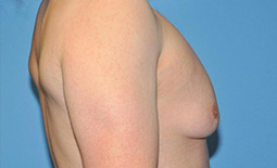 Gynecomastia Before and After Pictures Plano, TX