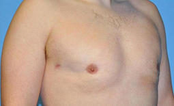 Gynecomastia Before and After Pictures Plano, TX