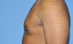 Gynecomastia Before and After Pictures Plano, TX