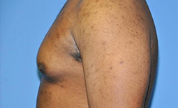 Gynecomastia Before and After Pictures Plano, TX