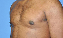 Gynecomastia Before and After Pictures Plano, TX