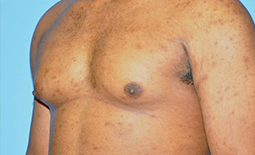 Gynecomastia Before and After Pictures Plano, TX