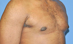 Gynecomastia Before and After Pictures Plano, TX