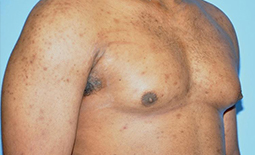 Gynecomastia Before and After Pictures Plano, TX