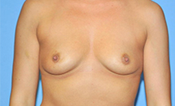 Breast Augmentation Before and After Pictures Plano, TX