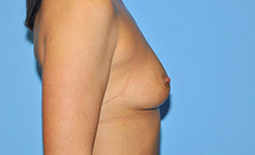 Breast Augmentation Before and After Pictures Plano, TX