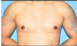 Gynecomastia Before and After Pictures Plano, TX