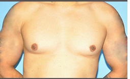 Gynecomastia Before and After Pictures Plano, TX