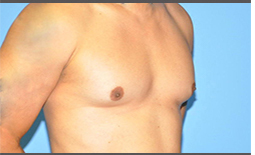 Gynecomastia Before and After Pictures Plano, TX