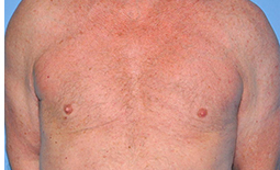 Gynecomastia Before and After Pictures Plano, TX