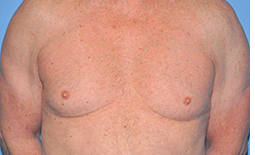 Gynecomastia Before and After Pictures Plano, TX