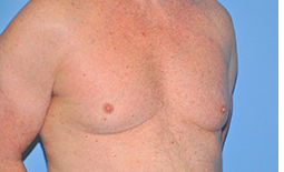 Gynecomastia Before and After Pictures Plano, TX