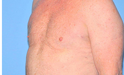 Gynecomastia Before and After Pictures Plano, TX