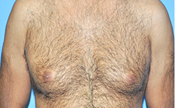 Gynecomastia Before and After Pictures Plano, TX