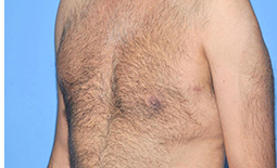 Gynecomastia Before and After Pictures Plano, TX