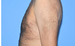 Gynecomastia Before and After Pictures Plano, TX