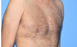 Gynecomastia Before and After Pictures Plano, TX