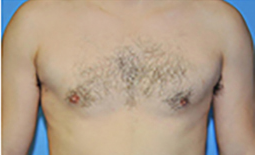 Gynecomastia Before and After Pictures Plano, TX