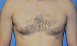 Gynecomastia Before and After Pictures Plano, TX