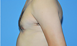 Gynecomastia Before and After Pictures Plano, TX