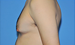 Gynecomastia Before and After Pictures Plano, TX