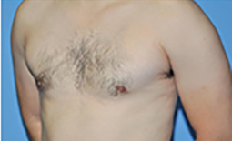 Gynecomastia Before and After Pictures Plano, TX