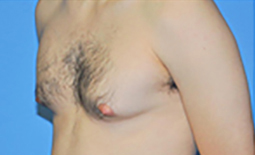 Gynecomastia Before and After Pictures Plano, TX