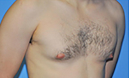 Gynecomastia Before and After Pictures Plano, TX