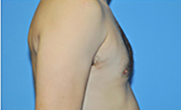 Gynecomastia Before and After Pictures Plano, TX