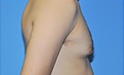 Gynecomastia Before and After Pictures Plano, TX