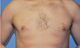 Gynecomastia Before and After Pictures Plano, TX