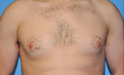 Gynecomastia Before and After Pictures Plano, TX