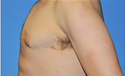 Gynecomastia Before and After Pictures Plano, TX