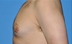 Gynecomastia Before and After Pictures Plano, TX