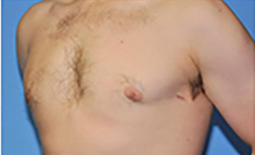 Gynecomastia Before and After Pictures Plano, TX