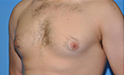 Gynecomastia Before and After Pictures Plano, TX