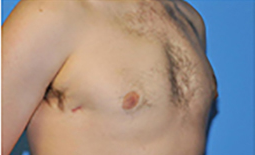 Gynecomastia Before and After Pictures Plano, TX