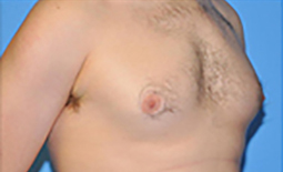 Gynecomastia Before and After Pictures Plano, TX