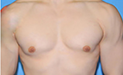 Gynecomastia Before and After Pictures Plano, TX