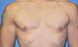 Gynecomastia Before and After Pictures Plano, TX