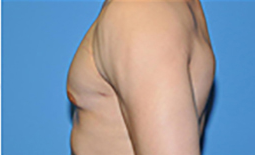 Gynecomastia Before and After Pictures Plano, TX