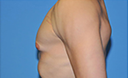 Gynecomastia Before and After Pictures Plano, TX