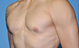 Gynecomastia Before and After Pictures Plano, TX