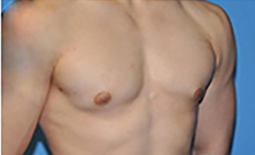 Gynecomastia Before and After Pictures Plano, TX